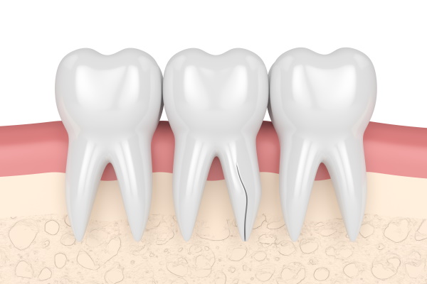3d render of gums with cracked tooth root over white background. Vertical fracture. Different types of broken teeth concept.コピー - コピー
