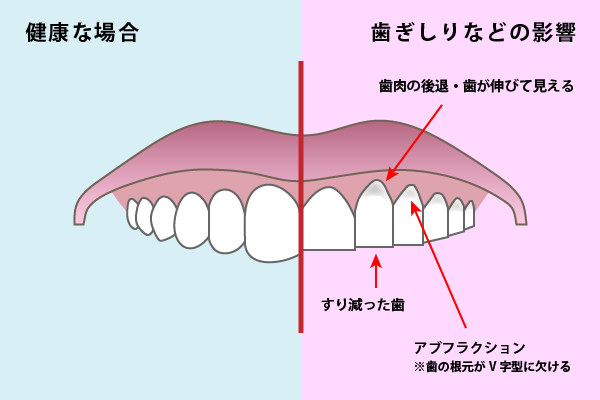 歯ぎしり くいしばり治療のサイト ボトックスによる治療 春日部の歯科医院